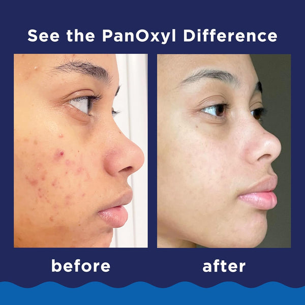ClearShield Acne Wash